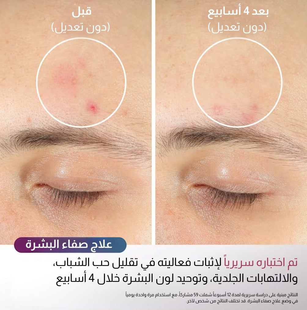 قناع الوجه Shark™ CryoGlow™ بتقنية LED الحمراء والزرقاء وتحت الحمراء مع تبريد تحت العين وحامل شحن (بلو فروست)