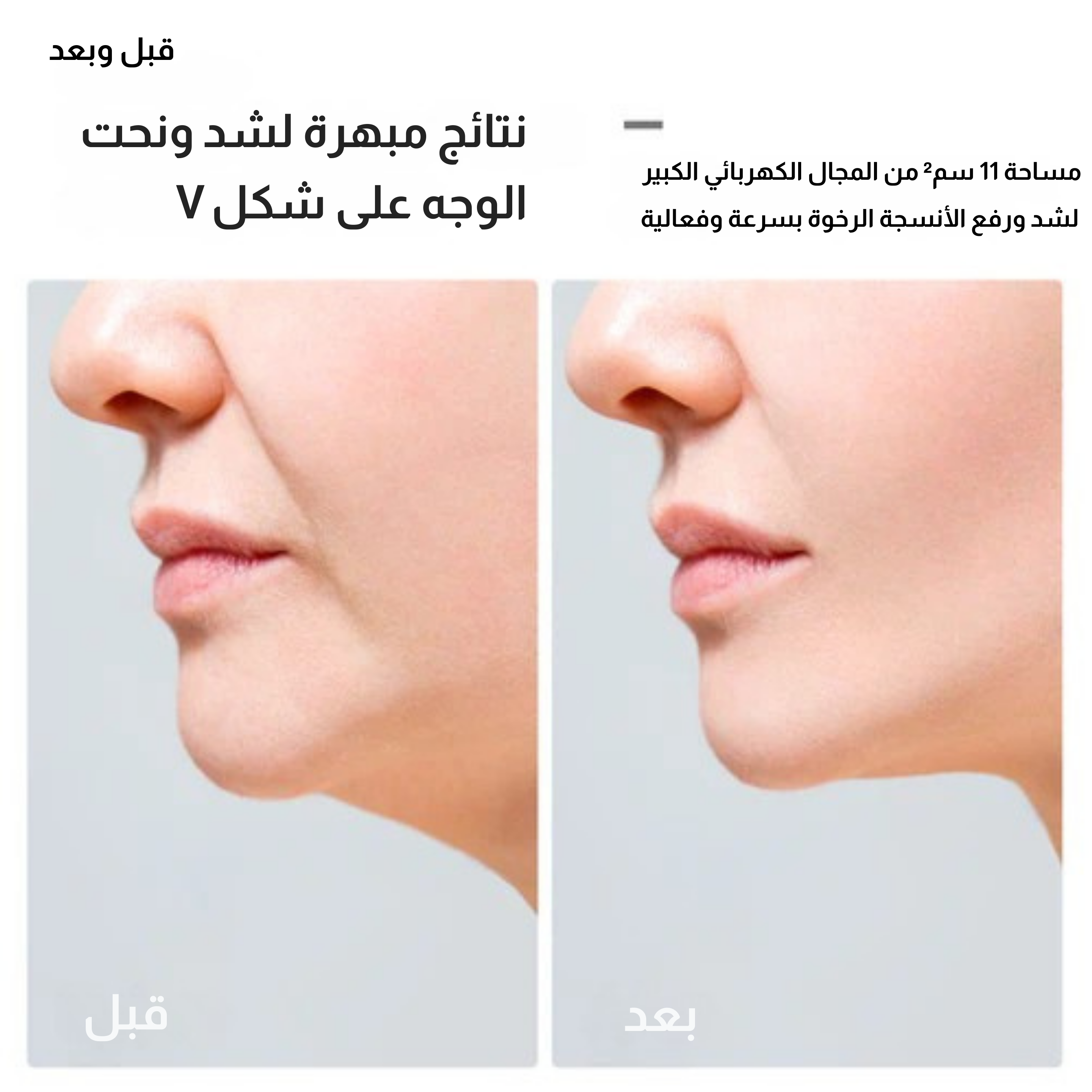 جهاز JOVS V-lift لشد الوجه 